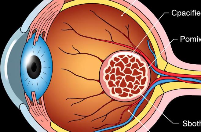 青光眼模型跨场景应用